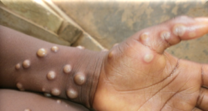 मंकीपॉक्स के व्यापक संक्रमण को रोकने के लिए सामाजिक दूरी और फेस मास्क है जरूरी